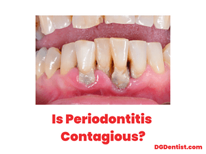Periodontitis in anterior teeth image