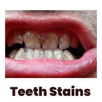 teeth stain turning teeth black graphical image