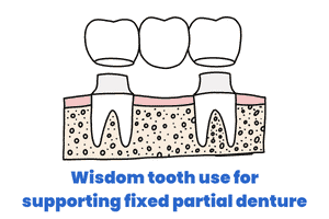 graphical representation of fixed partial denture